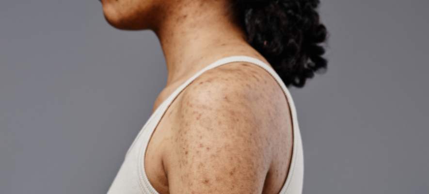 antiphospholipid syndrome